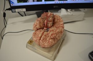 migraine story - brain