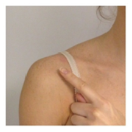 Location of a clavicle fracture