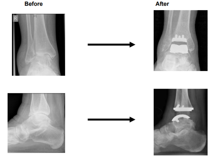X Ray showing before and after surgery pictures