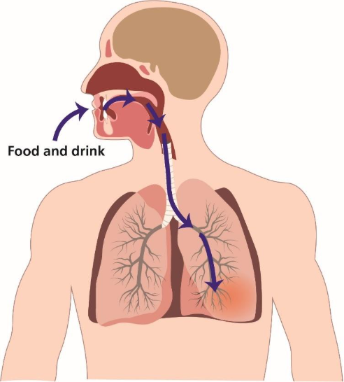 Image showing aspiration, the medical term for materials (like food or drink) entering the lungs.