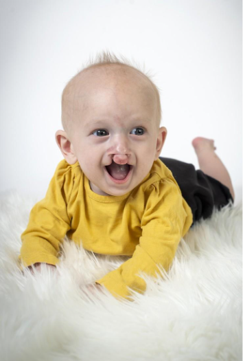A baby with a Cleft palate