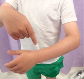 Image showing a buckle fracture.