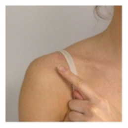 Shoulder dislocation injury 