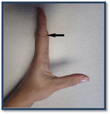 dislocation of finger