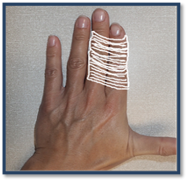 Location of a phalanx fractures.