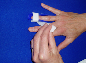 Fitting of a custom fit thermoplastic splint
