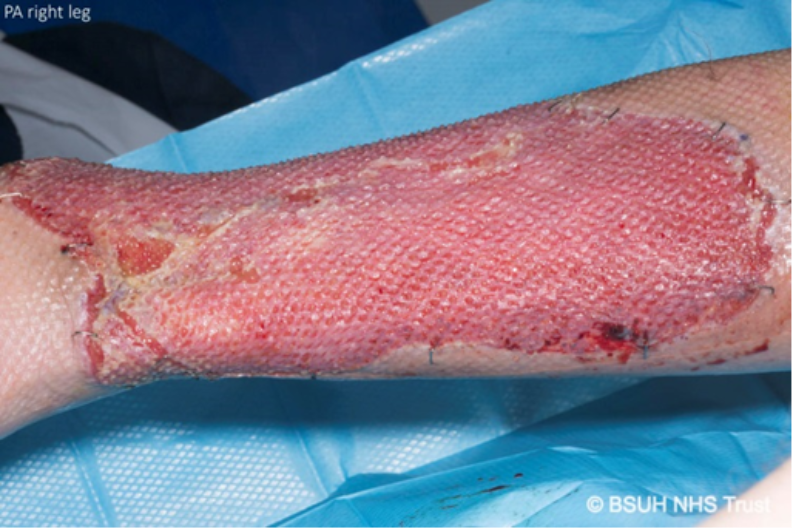 Skin graft