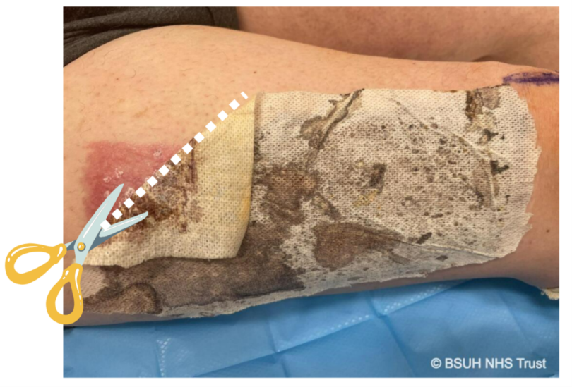 Image shows trimming back the dressing.