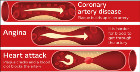 Figure 2. Illustration showing how coronary artery disease, angina and heart attack are caused. With thanks to the BHF