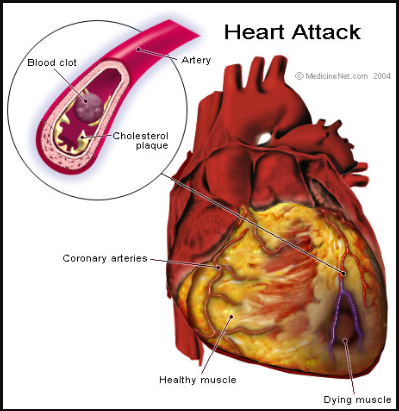 Figure 3. Illustration showing what happens in the heart during a heart attack. 