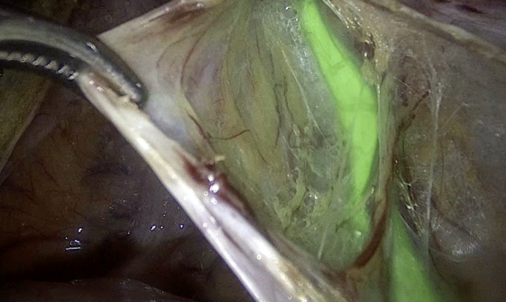 surgery technique green dye