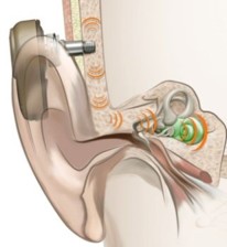 Diagram showing a percutaneous implant in place.