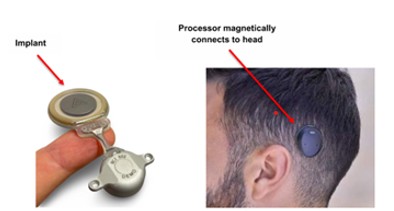 Illustration showing a middle ear implant and how it attaches magnetically to the head - 2