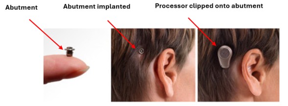 Illustration showing how an abutment and processor are fitted for a percutaneous implant