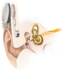 Illustration showing the implant and the processor connected magnetically to the head in a transcutaneous implant