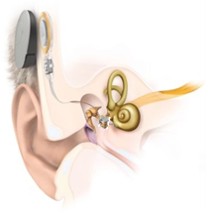 Illustration showing the middle ear implant in place